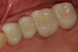 Tooth-Supported-Crown-4
